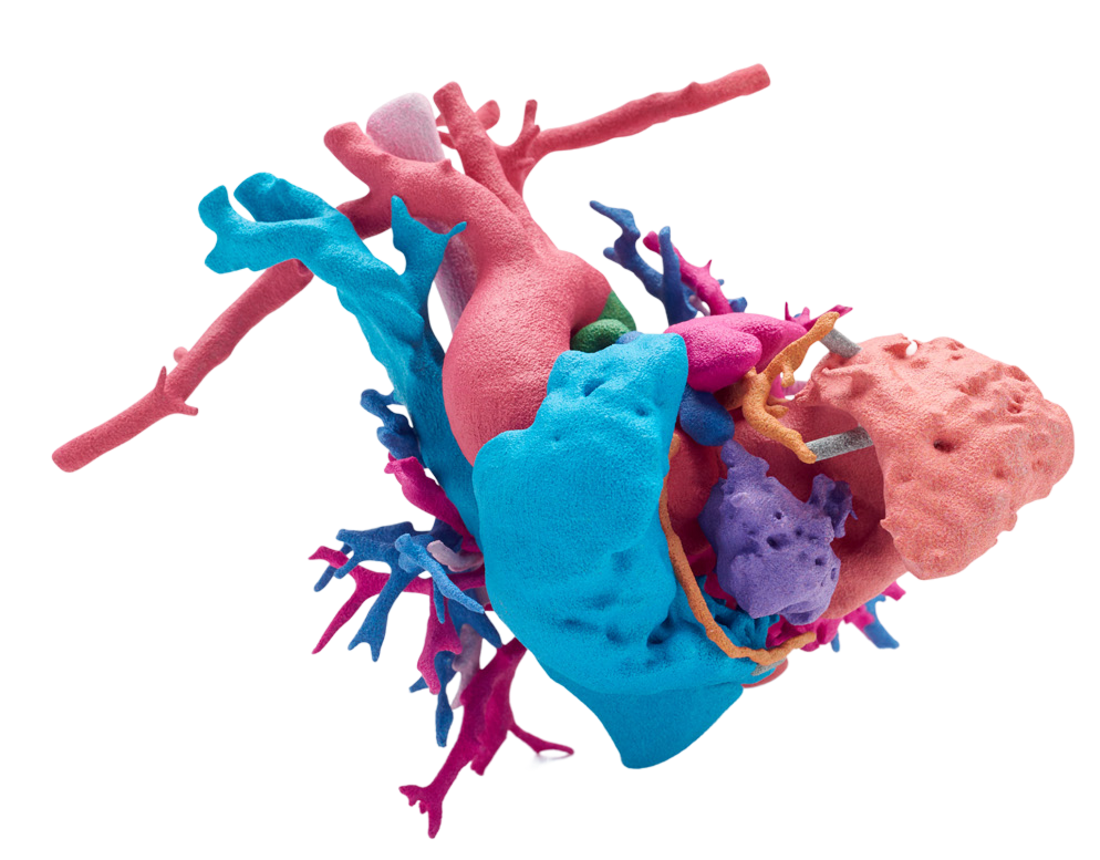 3D printed medical model